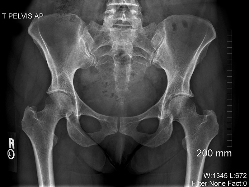 X-ray of pelvic